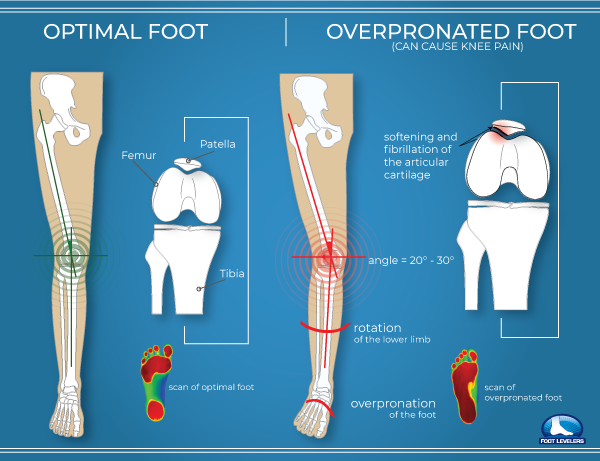 Over-pronated vs. Optimal Foot Balance - Custom Orthotics